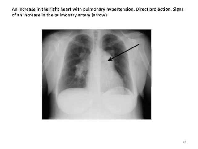 An increase in the right heart with pulmonary hypertension. Direct projection. Signs of