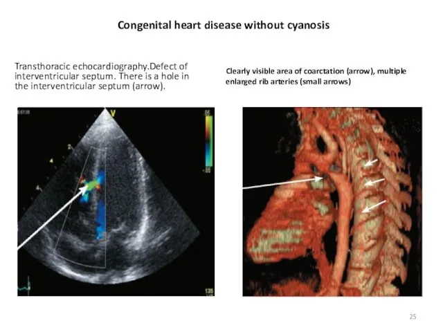 Congenital heart disease without cyanosis Transthoracic echocardiography.Defect of interventricular septum. There is a