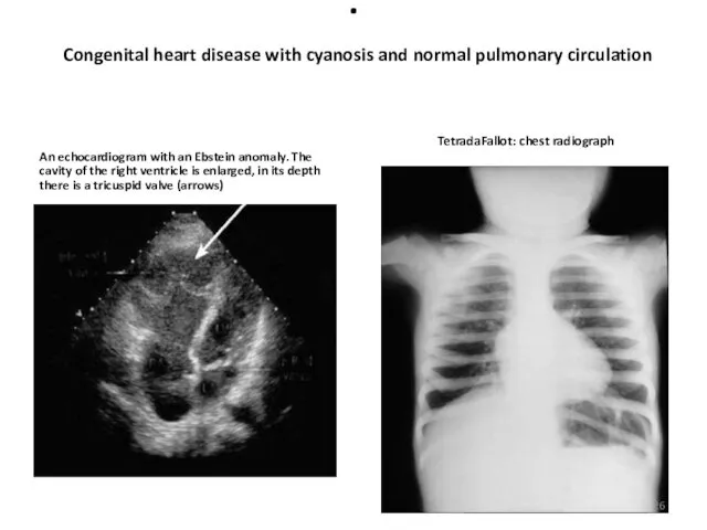 . Congenital heart disease with cyanosis and normal pulmonary circulation An echocardiogram with