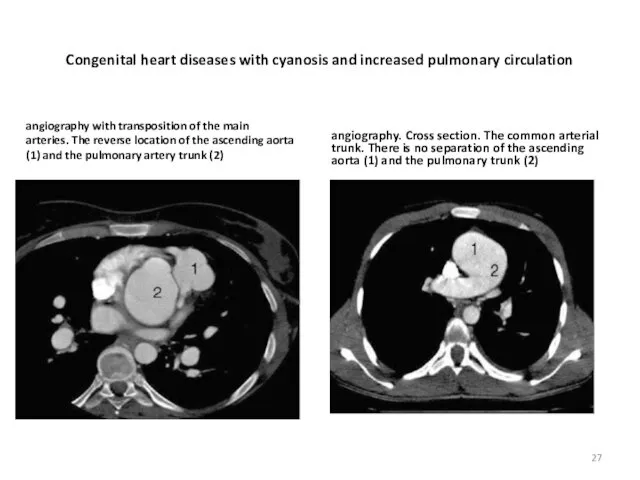 Congenital heart diseases with cyanosis and increased pulmonary circulation angiography