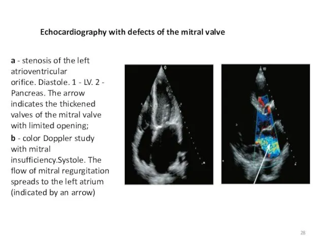 Echocardiography with defects of the mitral valve a - stenosis of the left