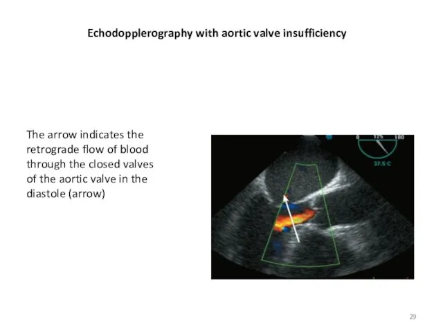 Echodopplerography with aortic valve insufficiency The arrow indicates the retrograde flow of blood
