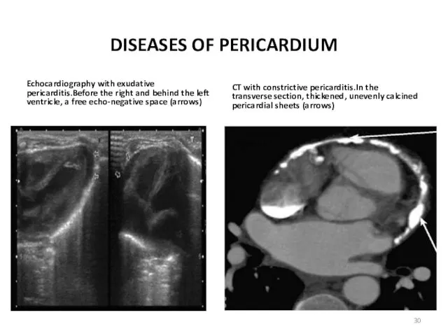 DISEASES OF PERICARDIUM Echocardiography with exudative pericarditis.Before the right and behind the left