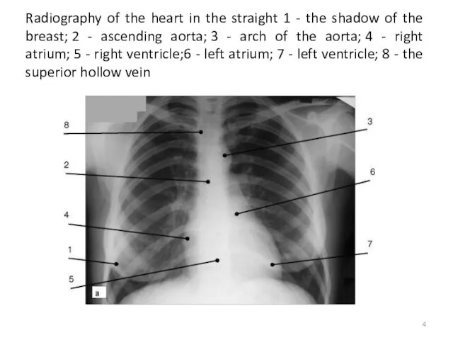 Radiography of the heart in the straight 1 - the shadow of the