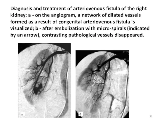 Diagnosis and treatment of arteriovenous fistula of the right kidney: a - on