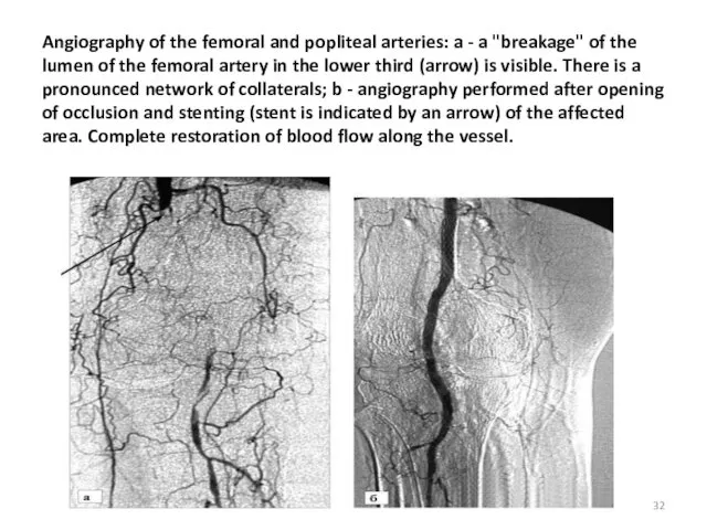 Angiography of the femoral and popliteal arteries: a - a "breakage" of the
