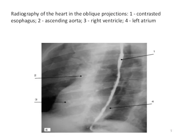 Radiography of the heart in the oblique projections: 1 - contrasted esophagus; 2