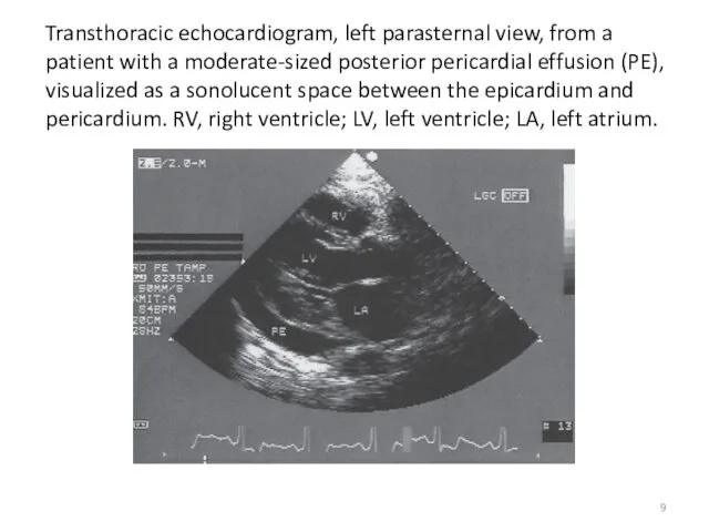 Transthoracic echocardiogram, left parasternal view, from a patient with a moderate-sized posterior pericardial
