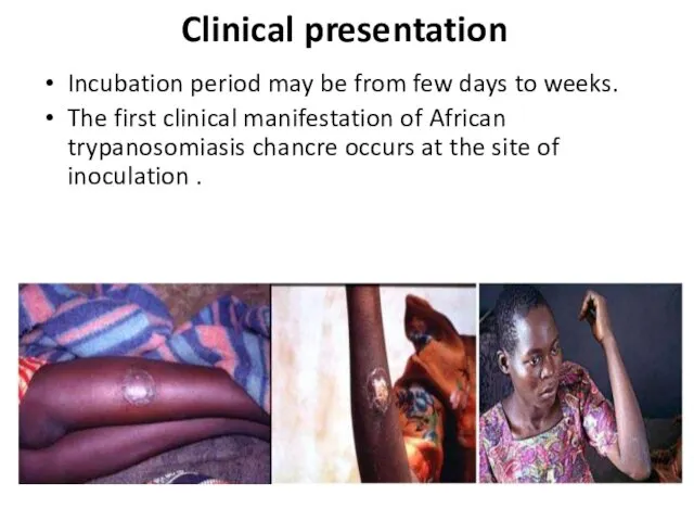 Clinical presentation Incubation period may be from few days to weeks. The first