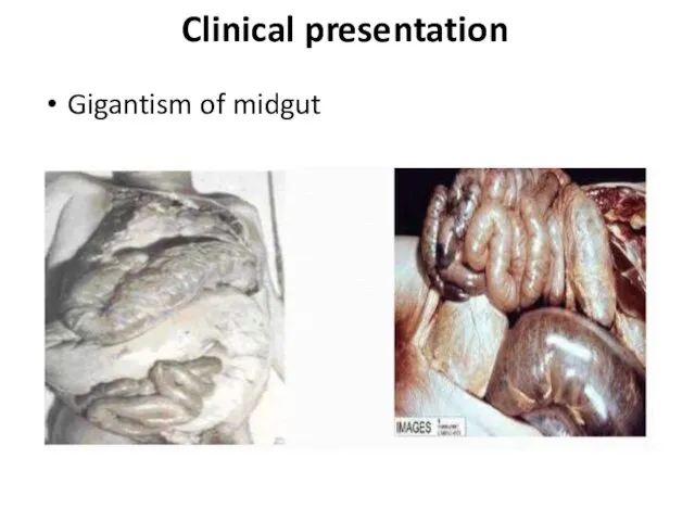 Gigantism of midgut Clinical presentation