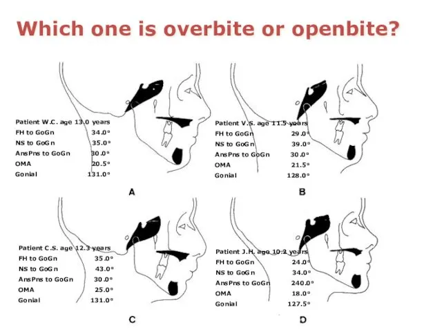 Which one is overbite or openbite? Patient W.C. age 13.0