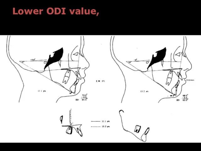 Lower ODI value, greater tendency toward open-bite