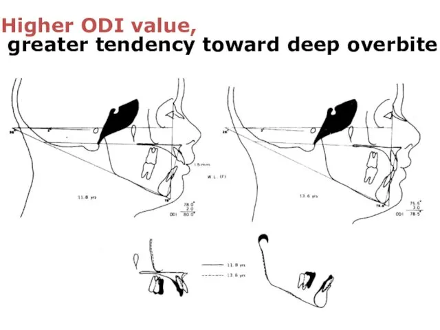 Higher ODI value, greater tendency toward deep overbite