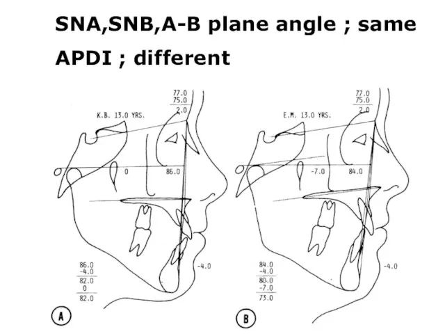 SNA,SNB,A-B plane angle ; same APDI ; different