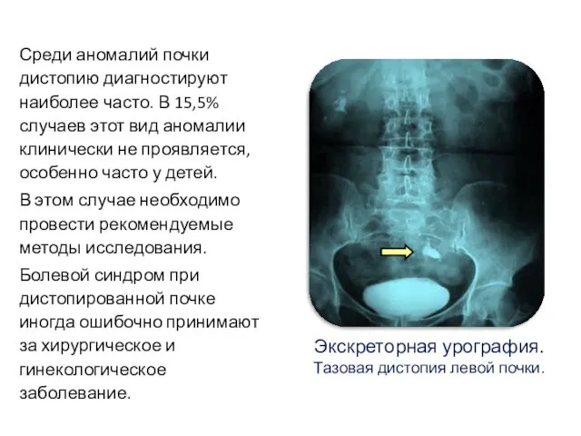 Среди аномалий почки дистопию диагностируют наиболее часто. В 15,5% случаев