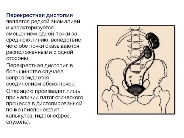 Перекрестная дистопия является редкой аномалией и характеризуется смещением одной почки