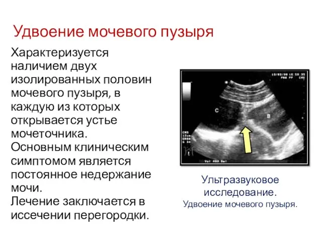 Характеризуется наличием двух изолированных половин мочевого пузыря, в каждую из