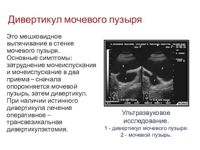 Это мешковидное выпячивание в стенке мочевого пузыря. Основные симптомы: затруднение