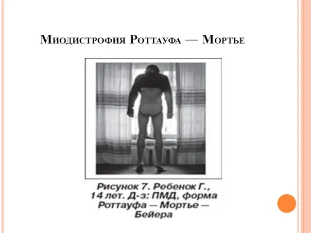 Миодистрофия Роттауфа — Мортье