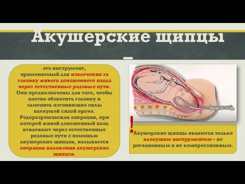 Акушерские щипцы – это инструмент, применяемый для извлечения за головку