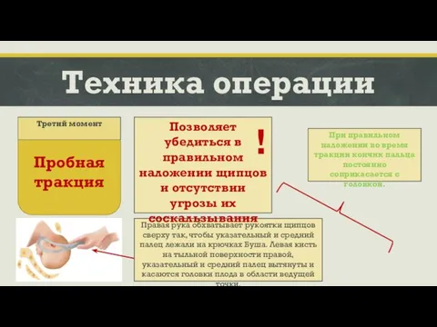 Техника операции Правая рука обхватывает рукоятки щипцов сверху так, чтобы