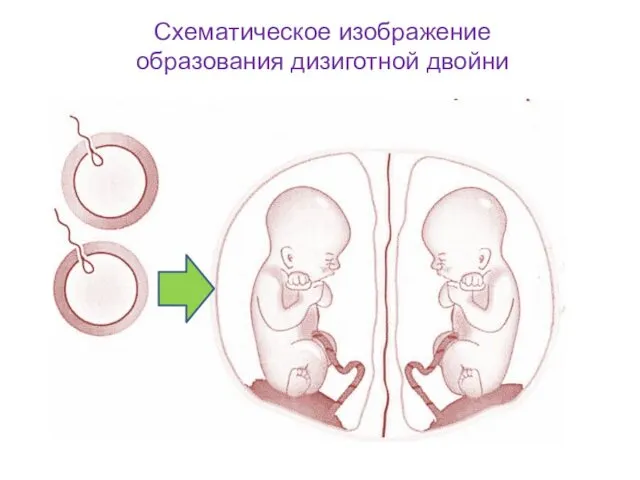 Схематическое изображение образования дизиготной двойни