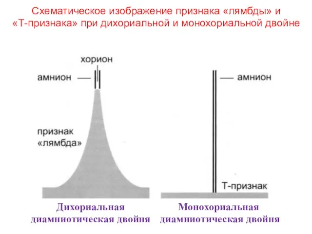 Схематическое изображение признака «лямбды» и «Т-признака» при дихориальной и монохориальной