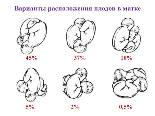 Варианты расположения плодов в матке 45% 37% 10% 5% 2% 0,5%