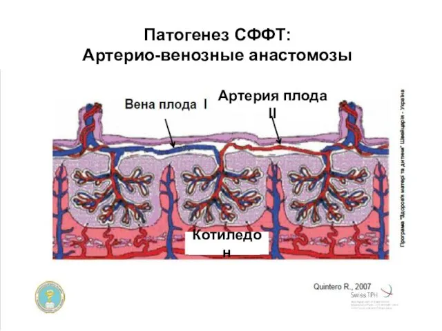 Патогенез СФФТ: Артерио-венозные анастомозы Котиледон Артерия плода ІІ