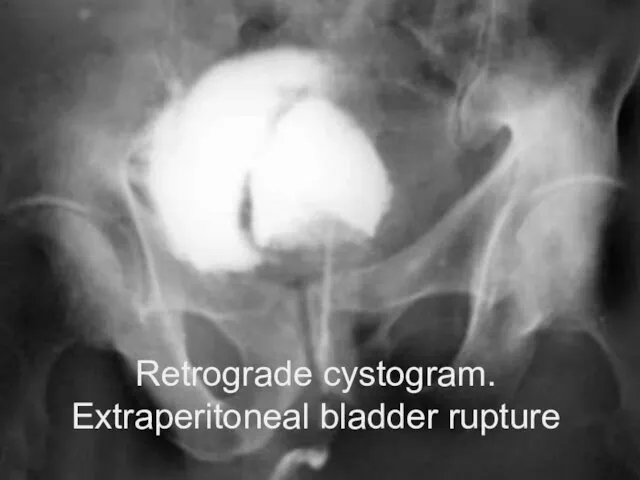 Retrograde cystogram. Extraperitoneal bladder rupture