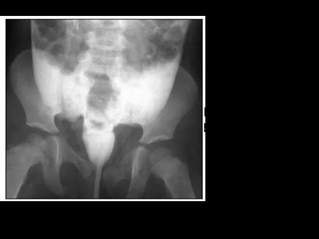 Intraperitoneal bladder rupture