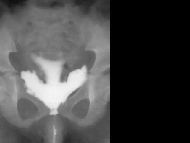 Flow of contrast fluid into paravesical space