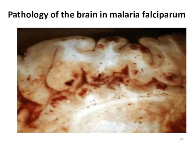 Pathology of the brain in malaria falciparum