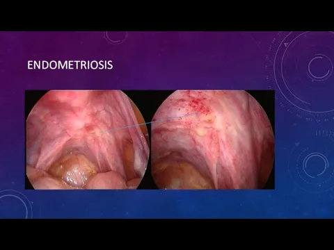 ENDOMETRIOSIS