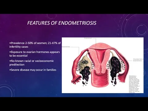 FEATURES OF ENDOMETRIOSIS •Prevalence 2-50% of women; 21-47% of infertility