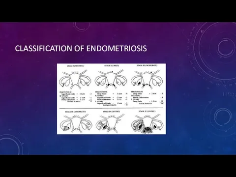 CLASSIFICATION OF ENDOMETRIOSIS