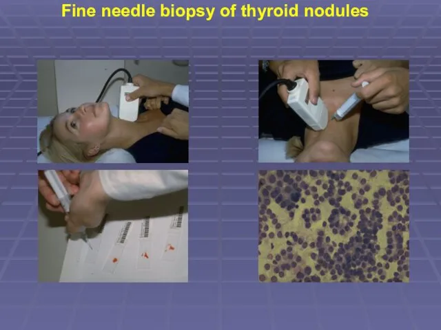 Fine needle biopsy of thyroid nodules