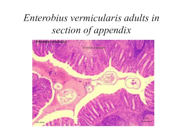 Enterobius vermicularis adults in section of appendix