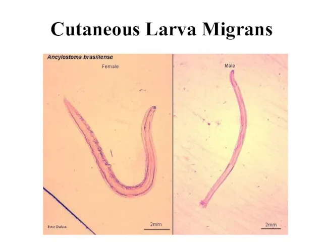 Cutaneous Larva Migrans