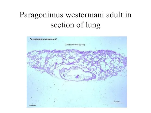 Paragonimus westermani adult in section of lung