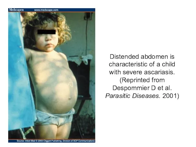 Distended abdomen is characteristic of a child with severe ascariasis. (Reprinted from Despommier