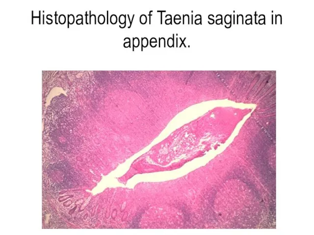 Histopathology of Taenia saginata in appendix.