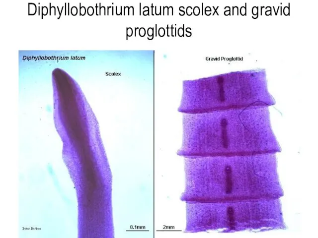 Diphyllobothrium latum scolex and gravid proglottids
