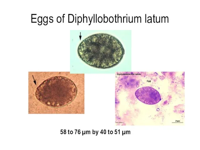 Eggs of Diphyllobothrium latum