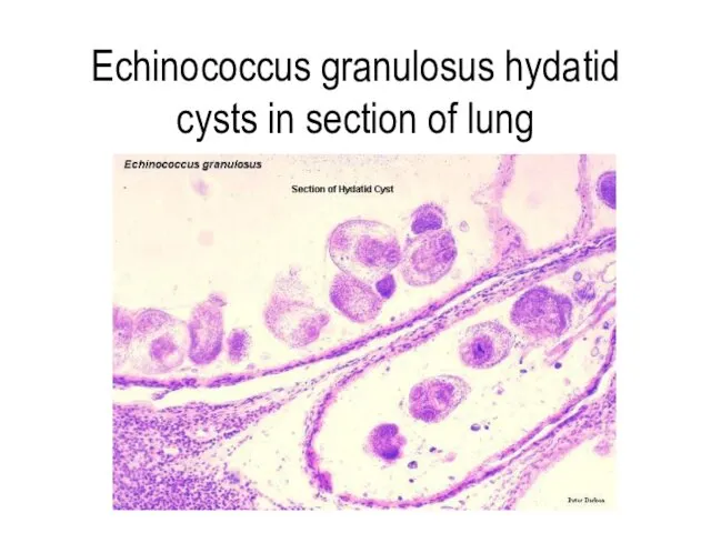 Echinococcus granulosus hydatid cysts in section of lung