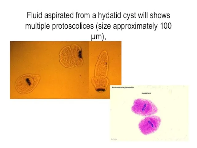 Fluid aspirated from a hydatid cyst will shows multiple protoscolices (size approximately 100 µm),