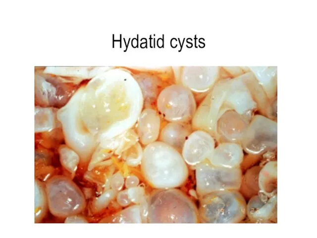 Hydatid cysts