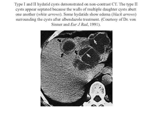 Type I and II hydatid cysts demonstrated on non-contrast CT. The type II