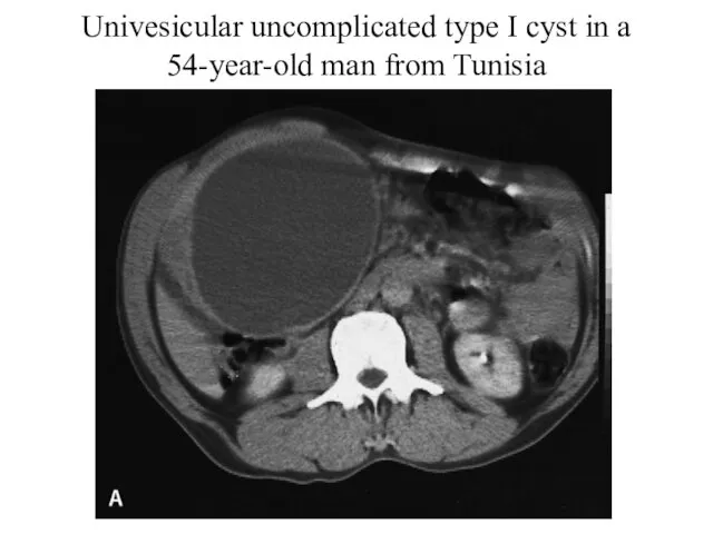 Univesicular uncomplicated type I cyst in a 54-year-old man from Tunisia