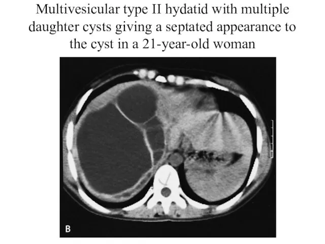 Multivesicular type II hydatid with multiple daughter cysts giving a septated appearance to